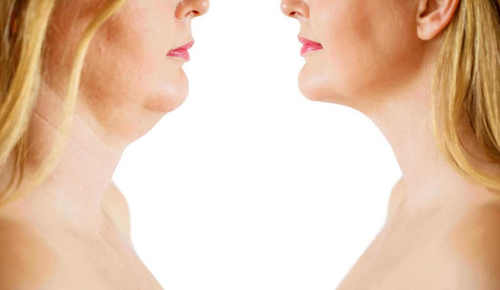 Double Chin treatment Longbridge before and after results