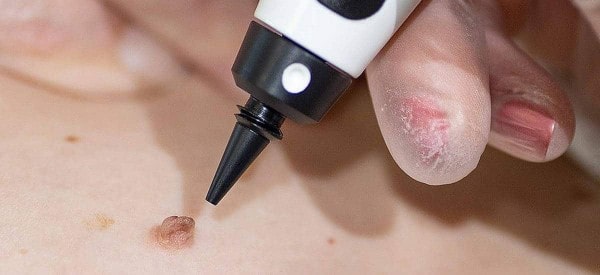 After Skin Tag Removal Longbridge