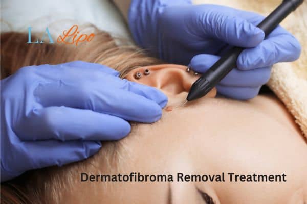 Dermatofibroma Removal Treatment Longbridge