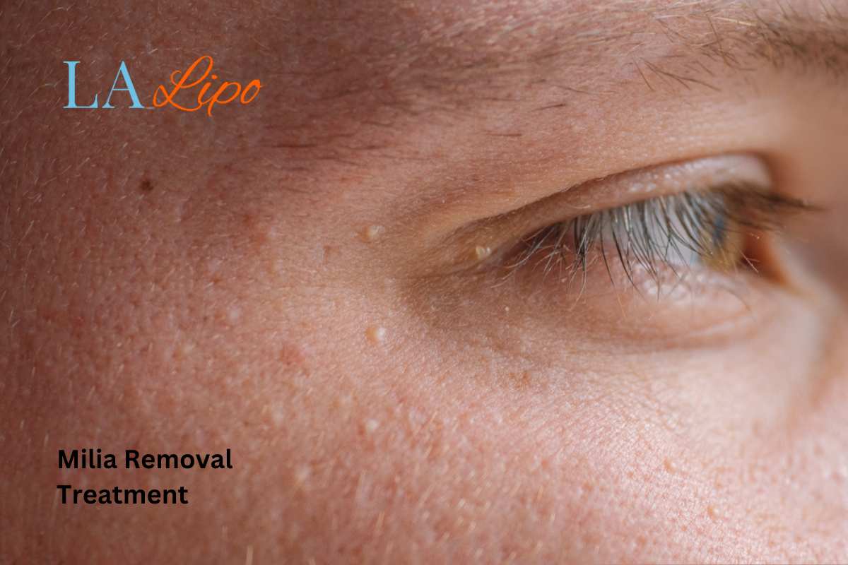 Cryopen Milia Removal: Is It the Easiest and Safest Option Longbridge?