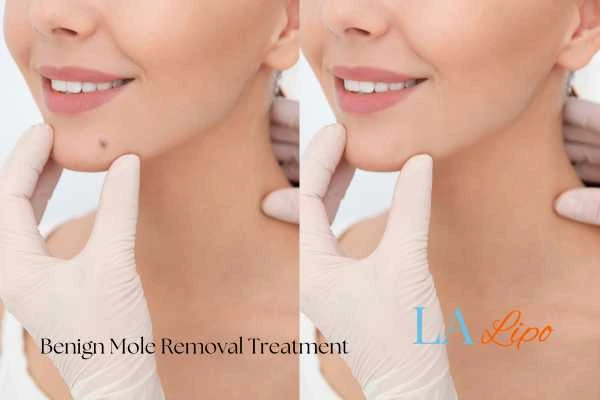 Before-and-after results following benign mole-removal treatment Longbridge