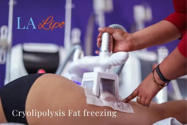 women getting fat freezing Longbridge