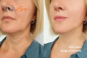 hi-fu for wrinkles Longbridge before and after results
