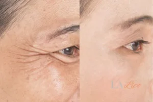 Before and after results of woman - HI-fu wrinkles reduction treatment Longbridge