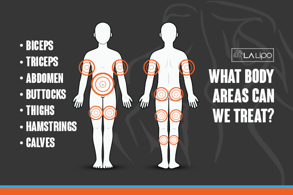Graphic to show areas you can have LA-EMS Body Sculpting Longbridge treatment.