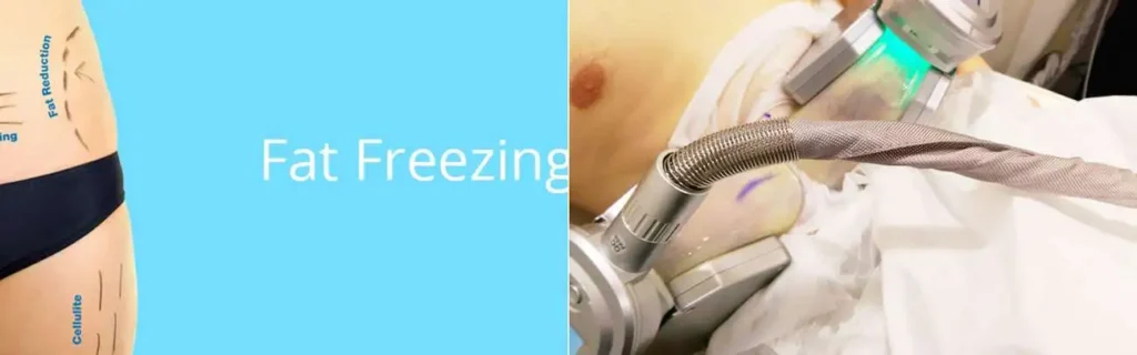 Fat freezing Longbridge on multiple areas of the body