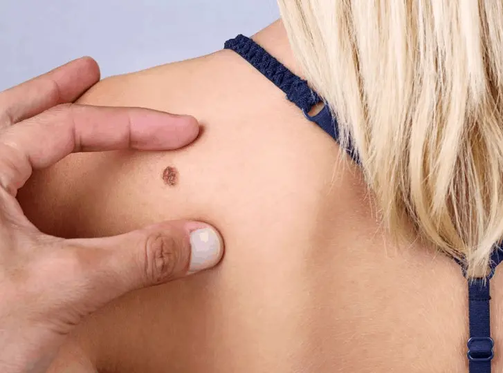 woman having mole removal Longbridge consultation before treatment.
