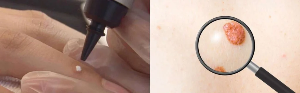 CryoPen practitioner Longbridge assessing a benign mole before treatment