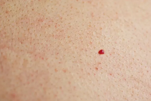 close up of a cherry angioma Longbridge