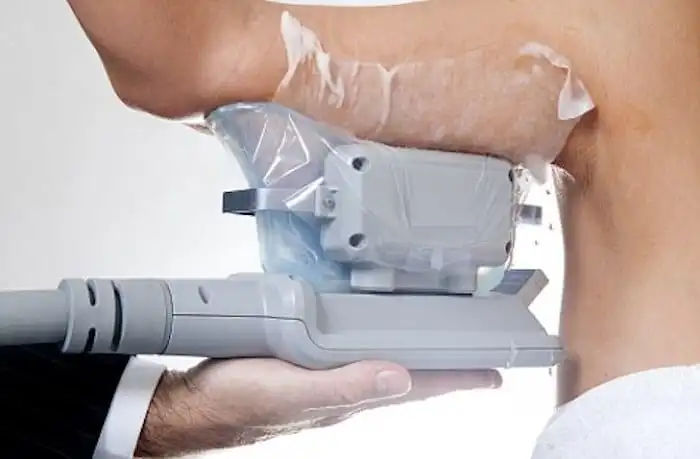 Picture of fat freezing Longbridge on the upper arms.