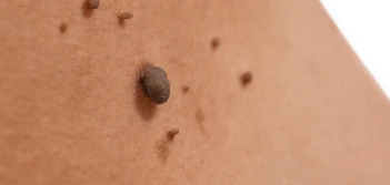 image of a skin tag Longbridge