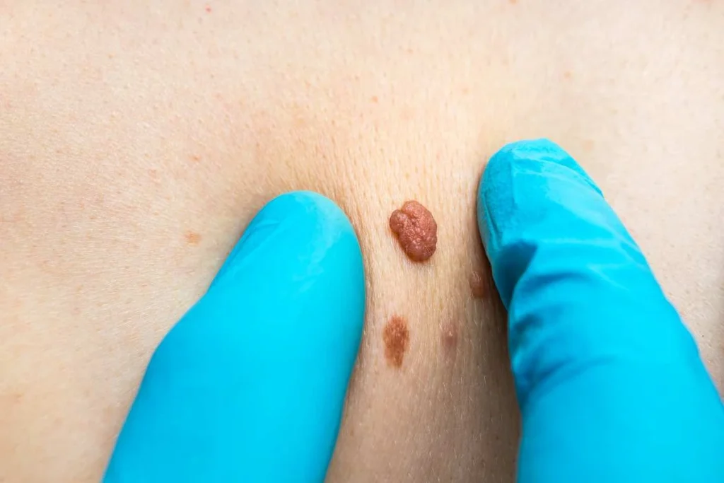 Consultant examining a skin tag Longbridge