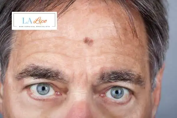 Solar Lentigo Removal Longbridge image of man with mark on his forehead