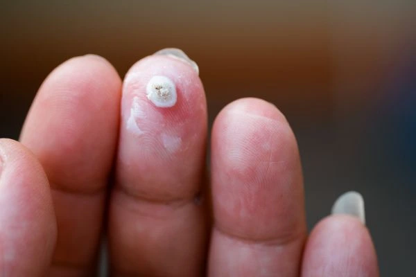 wart on person finger - cryotherapy to treat from LA LIPO Longbridge
