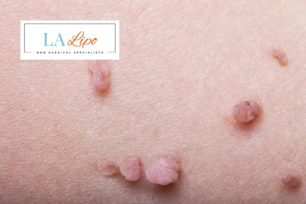 Does cryopen skin tag removal Longbridge hurt? Find out now call our team today!