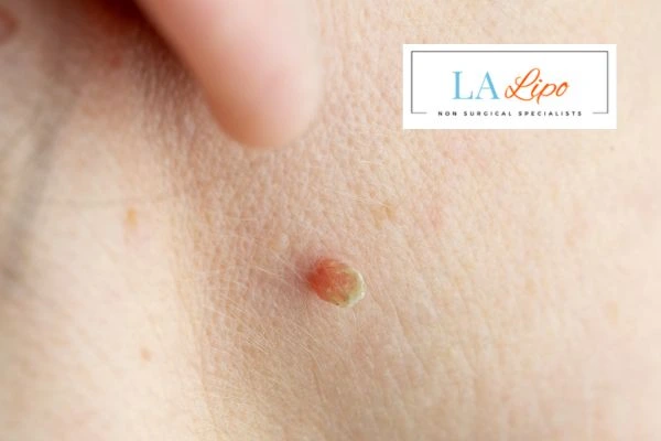 Book skin tag removal Longbridge today speak to our team now!