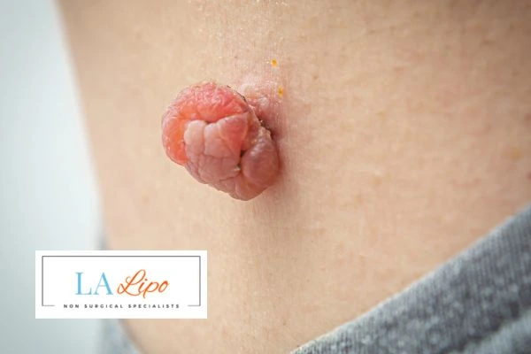 Interested in skin tag removal Longbridge? Concerned about the pain? Find out more today!