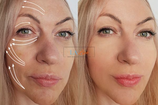Morpheus 8 results Longbridge face lift.