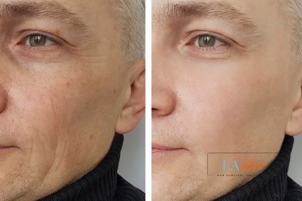 See the amazing results of Morpheus8 Treatment Longbridge!