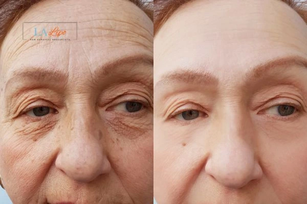 The powerful benefits of Morpheus8 Treatment Longbridge - Call Our team today!