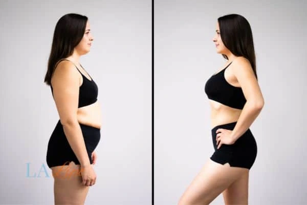 Picture of womans before and after using LA-EMS body sculpting to improve her core strength Longbridge