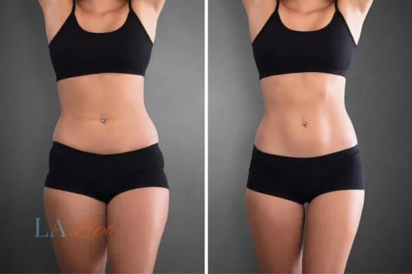 before and after results of non-surgical treatment to help a woman's body image and mental health Longbridge