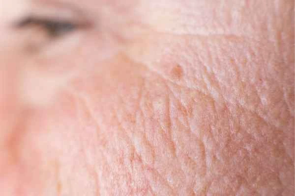 close up picture of a woman's face showing an age spot Longbridge