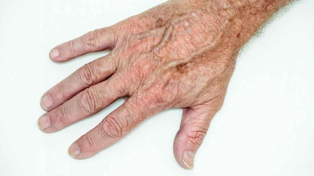 Male hand showing age spot Longbridge
