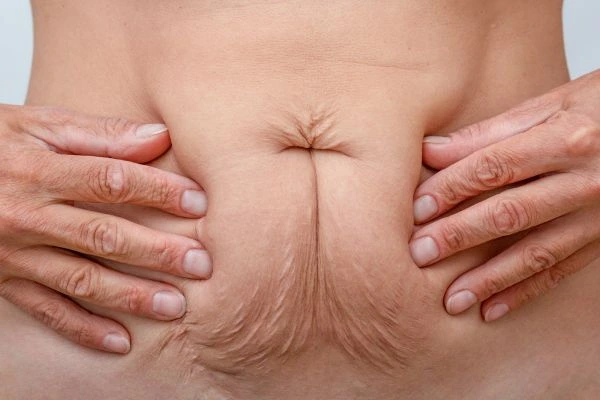 Image of a woman's stomach with loose skin - example of skin tightening Longbridge options