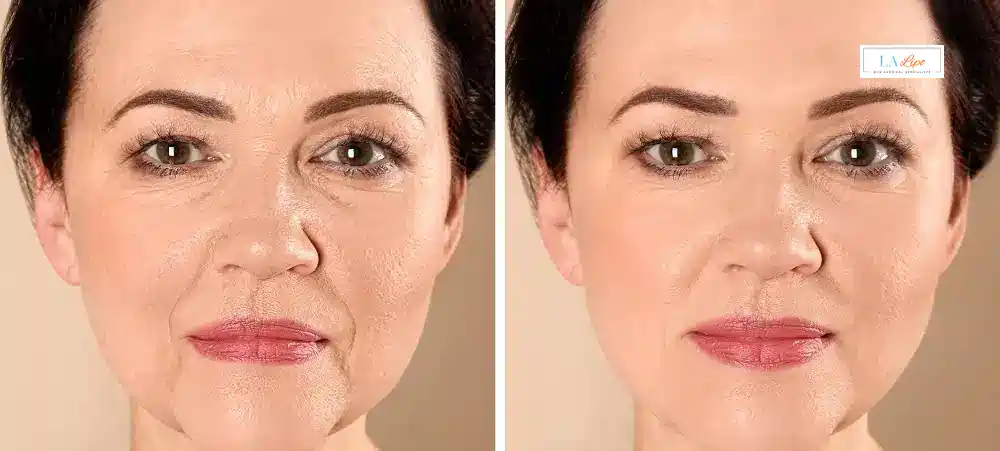 How Long Does It Take to See Results and How Long Do They Last Longbridge?