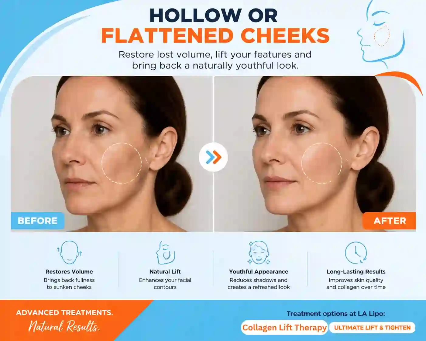 Sign #4: Hollow or Flattened Cheeks Longbridge