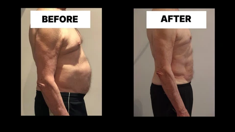 What Symptoms Can Diastasis Recti Cause in Men? Weak Core, Back Pain and Poor Posture Longbridge